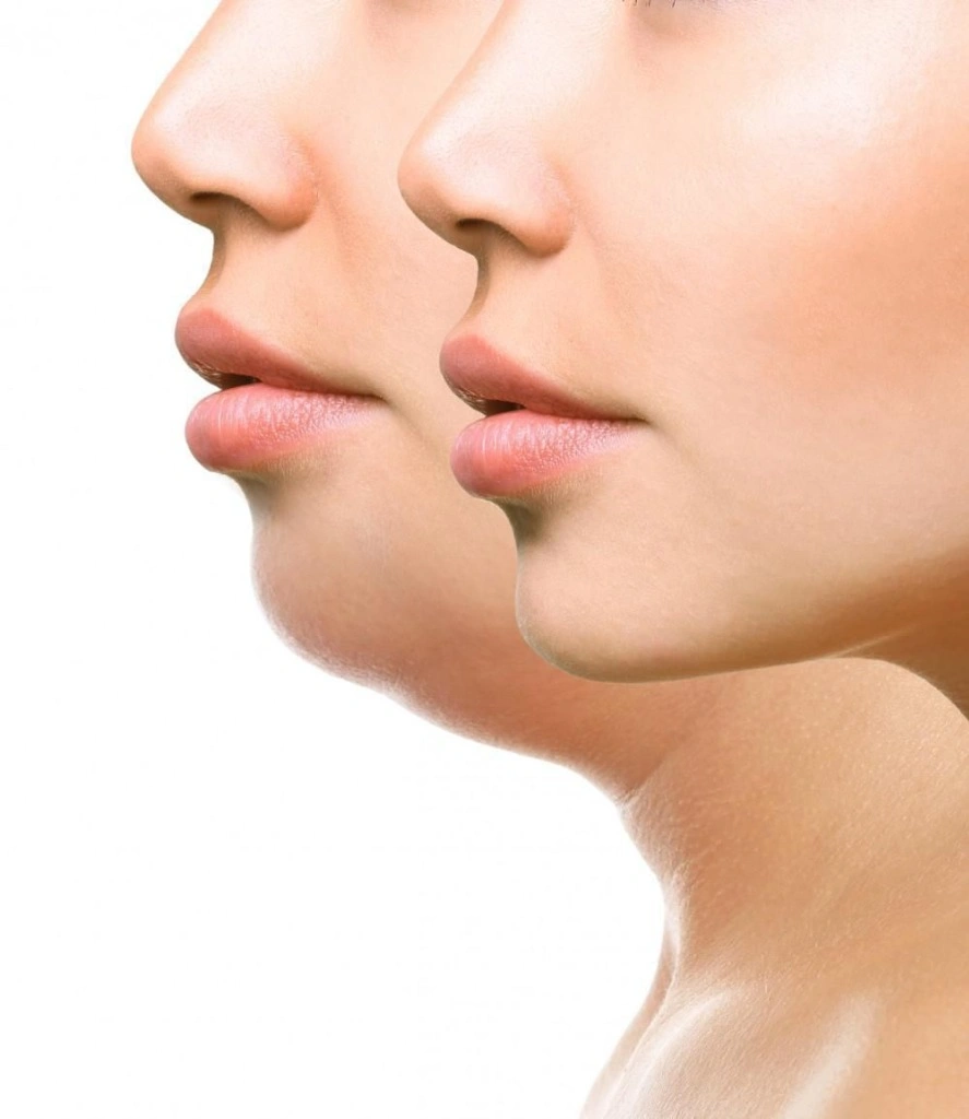 Lipo Mecânica de Papada com Dr. André Vinícius